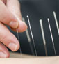 Acupuncture Outperforms Traditional Treatment in Relieving Pain